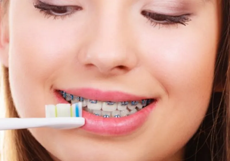 Jovem de aparelho ortodôntico escovando os dentes